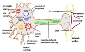 Advancements in Huntington Disease Gene Therapy