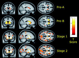 Insights into Huntington’s Disease: What You Need to Know