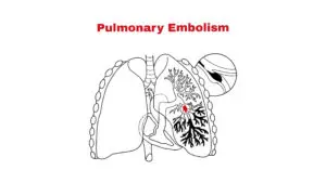 Understanding Pulmonary Embolism: Symptoms, Risks, and Treatments