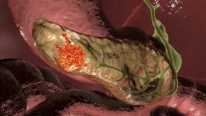 cancer patient — IN news